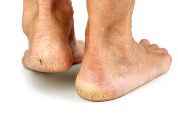 cracked heels