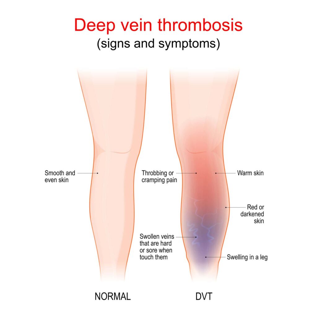 deep vein thrombosis