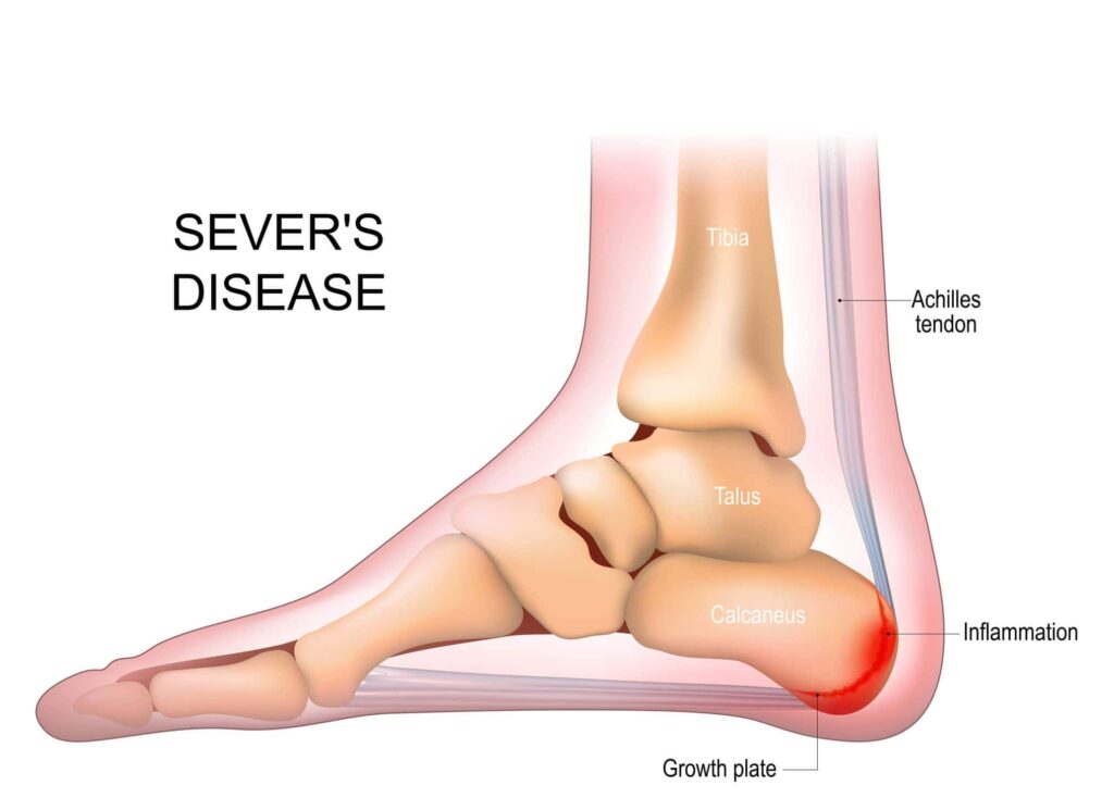 sever's disease